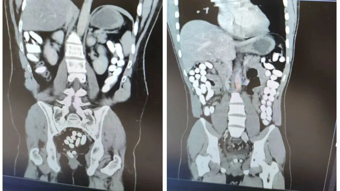 2 Kişinin Midesinden 2 Kilogram Uyuşturucu Çıktı
